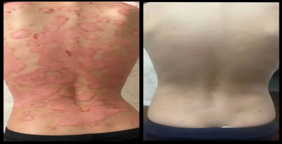 PSORIAZ 